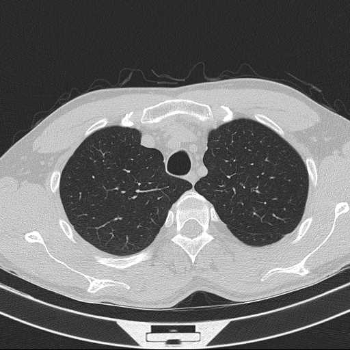 File:Bronchocele (Radiopaedia 60676-68429 Axial lung window 14).jpg