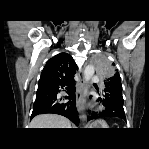Bronchogenic carcinoma (Radiopaedia 73497-84262 C 78).jpg