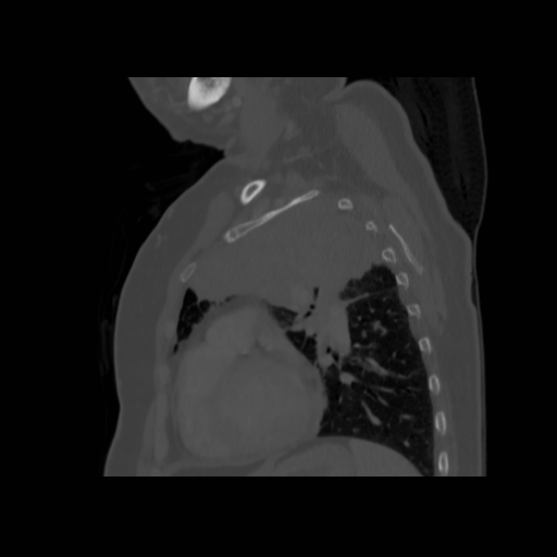 Bronchogenic carcinoma (Radiopaedia 73497-84262 Sagittal bone window 108).jpg