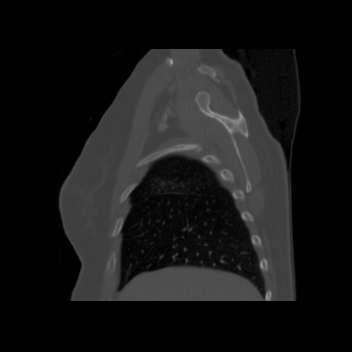 Bronchogenic carcinoma (Radiopaedia 73497-84262 Sagittal bone window 36).jpg