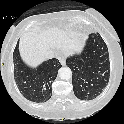File:Bronchogenic carcinoma as an incidental finding (Radiopaedia 16453-16130 Axial lung window 32).jpg