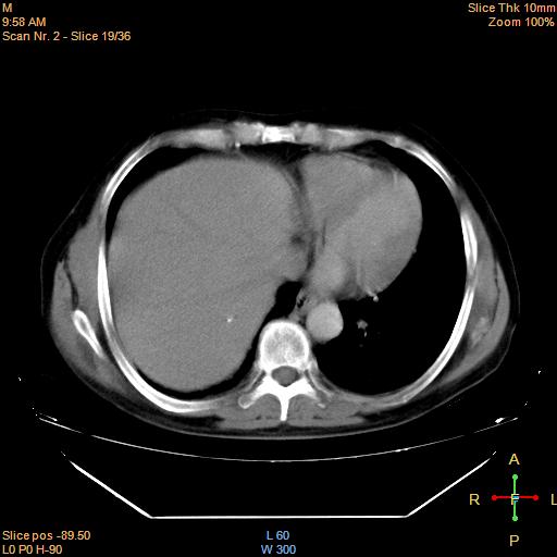 File:Bronchogenic carcinoma with superior vena caval invasion (Radiopaedia 22378-22406 Axial liver window 17).jpg