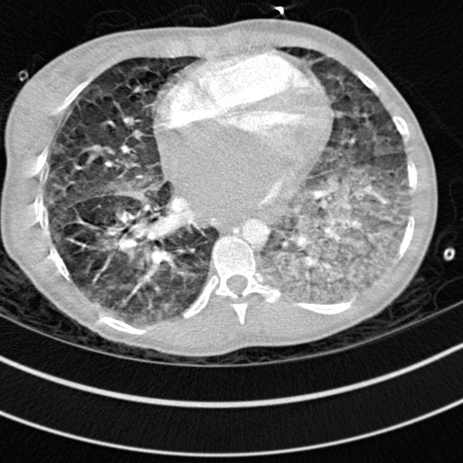 Bronchogenic cyst (Radiopaedia 77801-90071 Axial lung window 53).jpg