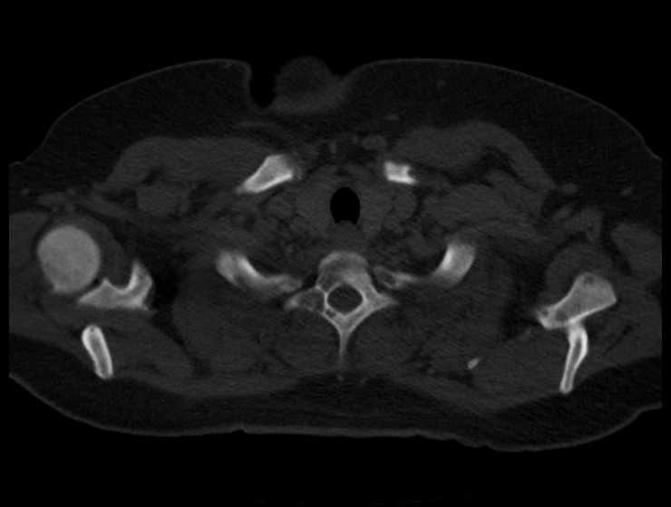 Brown tumors compressing the spinal cord (Radiopaedia 68442-77988 Axial bone window 6).jpg