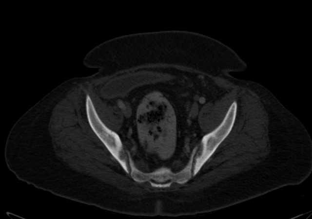 Brown tumors compressing the spinal cord (Radiopaedia 68442-77988 G 104).jpg