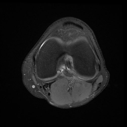 File:Bucket-handle meniscus tear (Radiopaedia 65700-74809 Axial PD fat sat 16).jpg