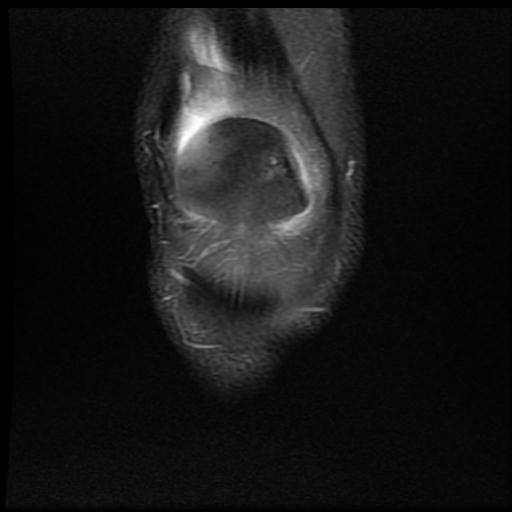 File:Bucket handle tear - medial meniscus (Radiopaedia 69245-79026 Coronal PD fat sat 2).jpg