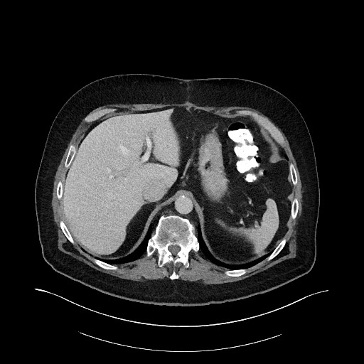Buried bumper syndrome - gastrostomy tube (Radiopaedia 63843-72575 A 9).jpg