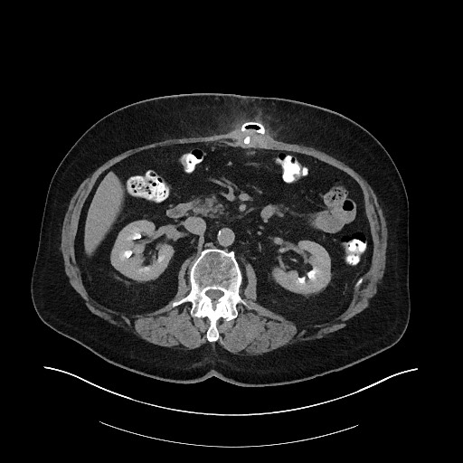 File:Buried bumper syndrome - gastrostomy tube (Radiopaedia 63843-72575 Axial Inject 13).jpg