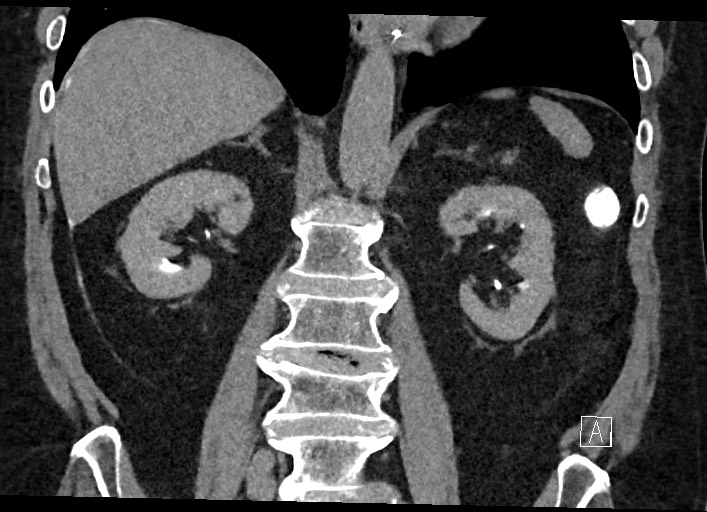 Buried bumper syndrome - gastrostomy tube (Radiopaedia 63843-72577 Coronal Inject 84).jpg