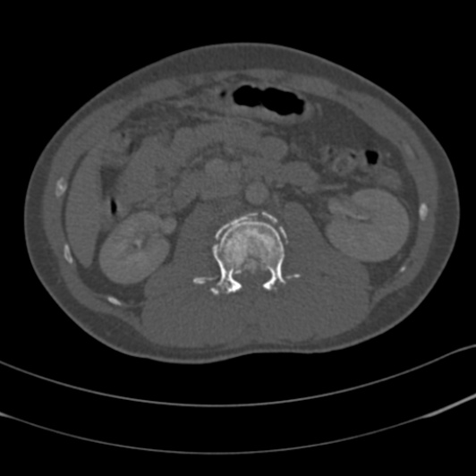 Burst fracture with cauda equina syndrome (Radiopaedia 25701-25867 Axial bone window 43).jpg