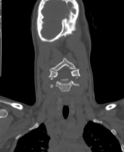Butterfly vertebra (Radiopaedia 77903-90209 Coronal bone window 1).jpg