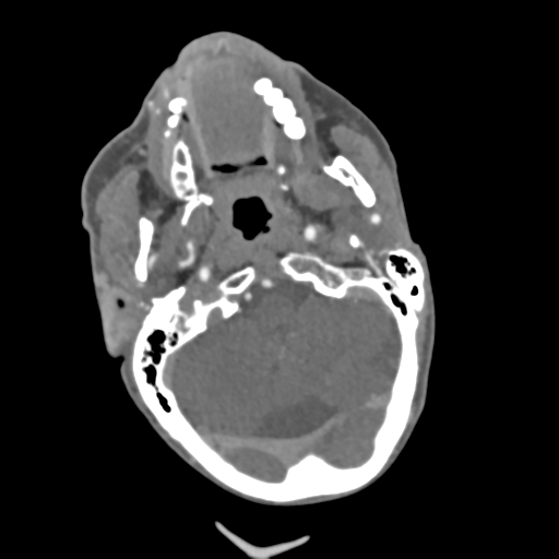 C2 fracture with vertebral artery dissection (Radiopaedia 37378-39200 A 192).png
