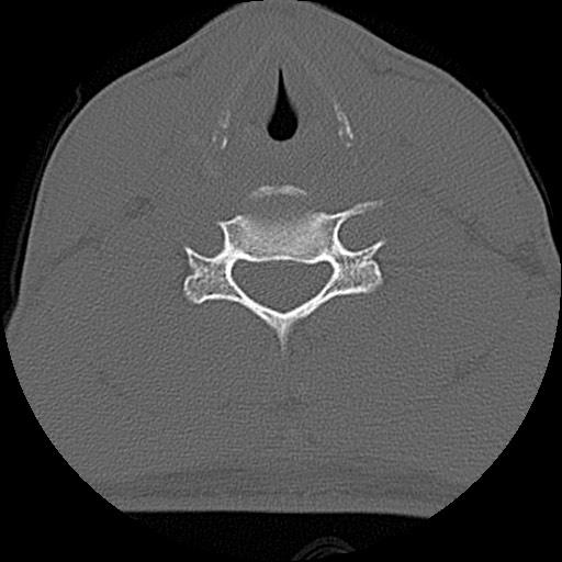 File:C5 facet fracture (Radiopaedia 58374-65499 Axial bone window 60).jpg