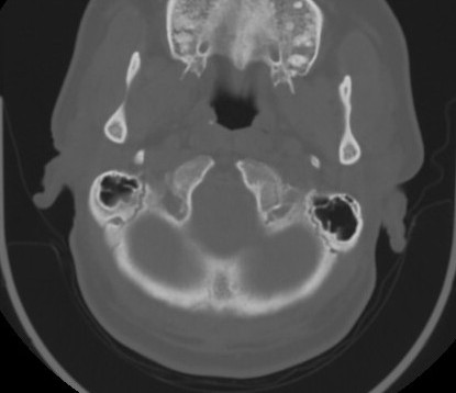 C7 laminar fracture and Klippel-Feil syndrome (Radiopaedia 86710-102850 Axial bone window 19).jpg