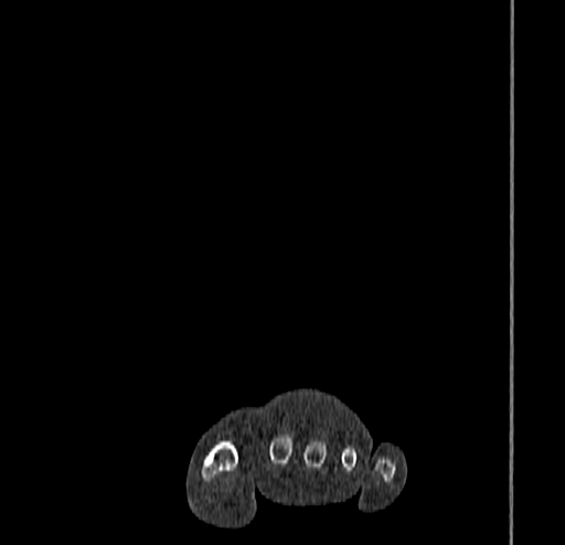 Calcaneal fracture - Sanders type 4 (Radiopaedia 90179-107370 Coronal bone window 16).jpg