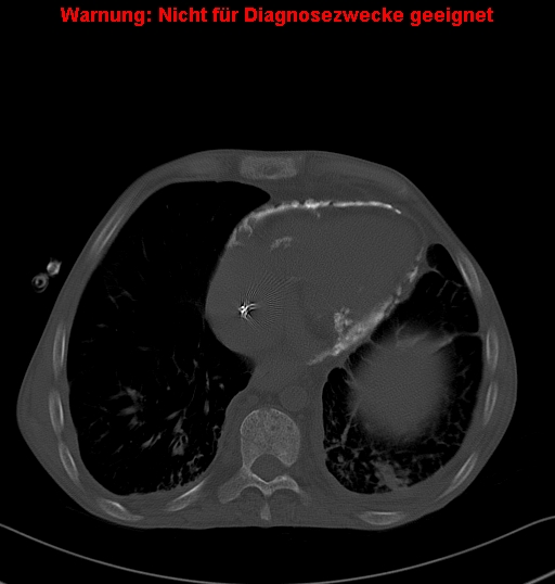 File:Calcific constrictive pericarditis (Radiopaedia 24701-24967 Axial bone window 22).jpg