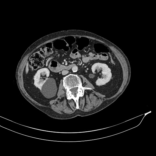 Calcified adrenal glands and Spigelian hernia (Radiopaedia 49741-54988 A 105).jpg