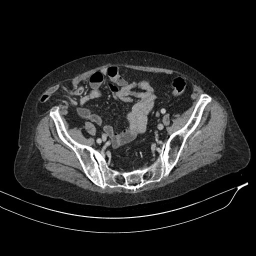 Calcified adrenal glands and Spigelian hernia (Radiopaedia 49741-54988 A 186).jpg