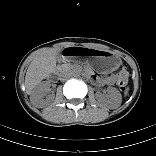 File:Calcified hepatic hydatid cyst (Radiopaedia 83870-99072 Axial non-contrast 71).jpg