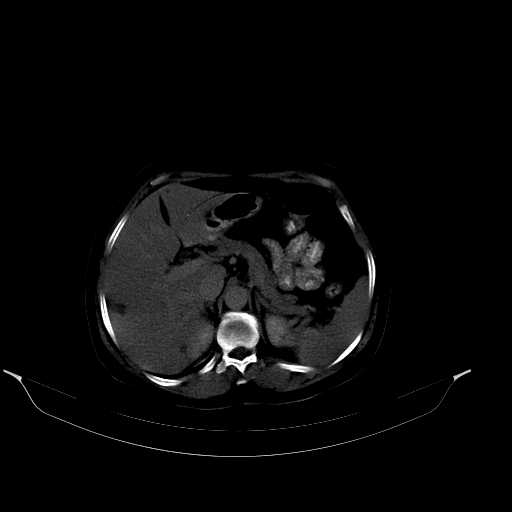 File:Calcified hydatid cyst of the liver (Radiopaedia 21212-21112 Axial bone window 16).jpg