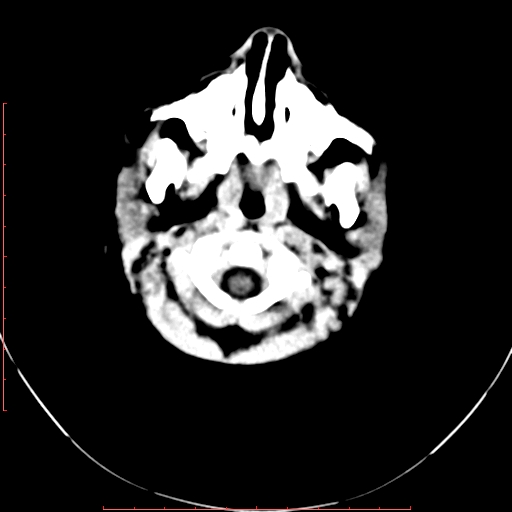 File:Calcified middle cerebral artery embolism (Radiopaedia 78949-91860 Axial non-contrast 1).jpg