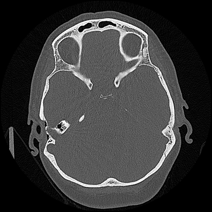 Canal up mastoidectomy (Radiopaedia 78108-90638 Axial bone window 109).jpg