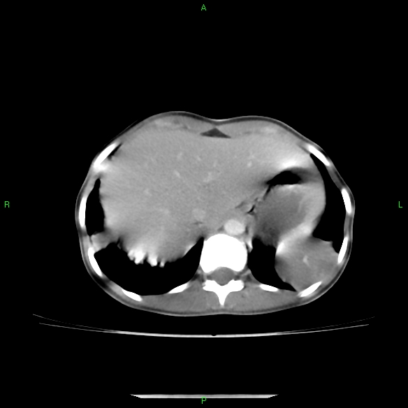 File:Cannon ball metastases - synovial sarcoma (Radiopaedia 26135-26271 C 33).jpg