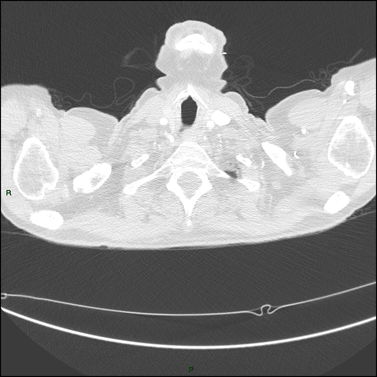 Cannonball metastases (Radiopaedia 82110-96150 Axial lung window 16).jpg
