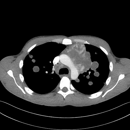 Cannonball metastases - testicular choriocarcinoma (Radiopaedia 84510-99891 B 46).jpg
