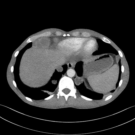 File:Cannonball metastases - testicular choriocarcinoma (Radiopaedia 84510-99891 B 91).jpg