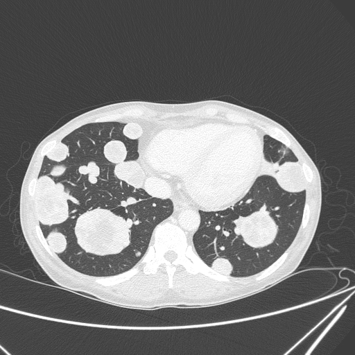 File:Canonball lung metastasis (Radiopaedia 77634-89837 Axial lung window 134).jpg