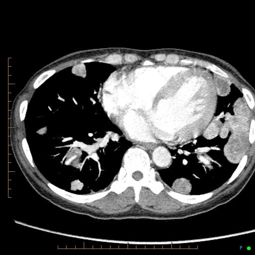 Canonball lung metastasis (Radiopaedia 77634-89837 B 67).jpg