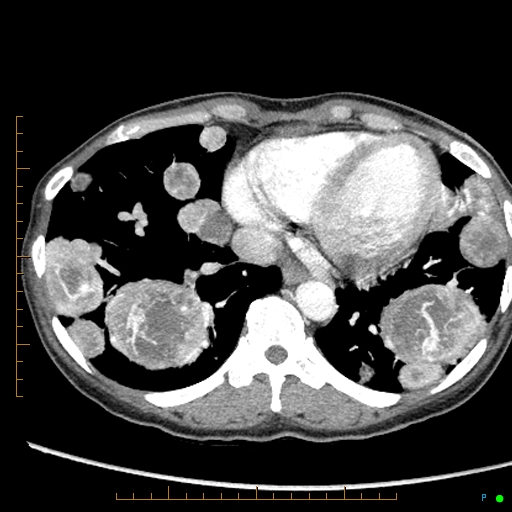 Canonball lung metastasis (Radiopaedia 77634-89837 B 76).jpg