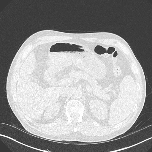 Caplan syndrome (Radiopaedia 56667-63530 Axial lung window 199).jpg
