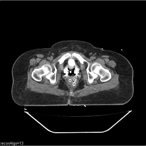 Carcinoma cervix- brachytherapy applicator (Radiopaedia 33135-34173 Axial non-contrast 39).jpg