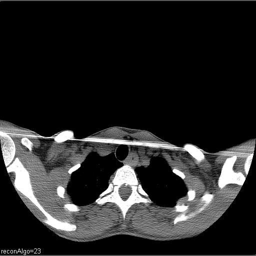 Carcinoma of the maxillary antrum (Radiopaedia 53805-59888 Axial non-contrast 3).jpg