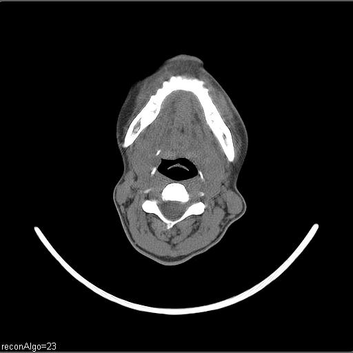 Carcinoma of the maxillary antrum (Radiopaedia 53805-59888 Axial non-contrast 38).jpg