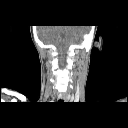 Carcinoma of the maxillary antrum (Radiopaedia 53805-59888 Coronal C+ delayed 118).jpg