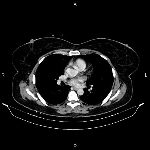 Carcinoma of uterine cervix (Radiopaedia 85861-101700 A 20).jpg