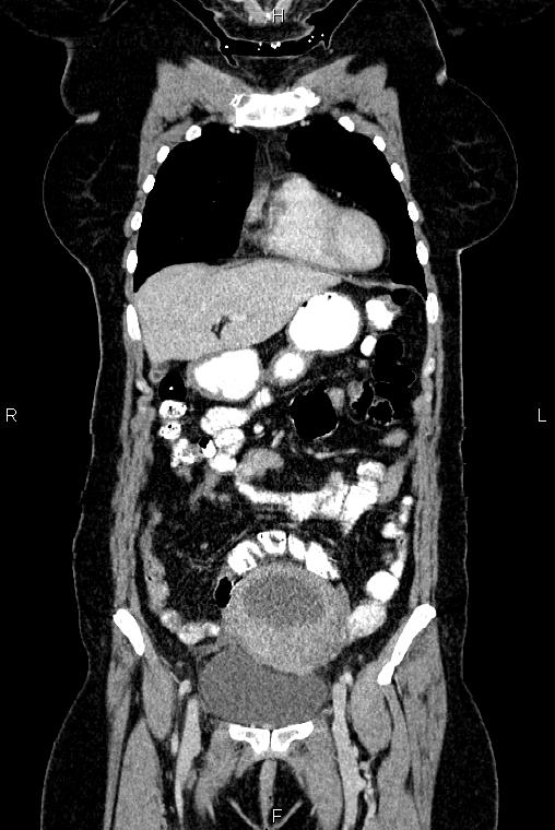 Carcinoma of uterine cervix (Radiopaedia 85861-101700 C 12).jpg