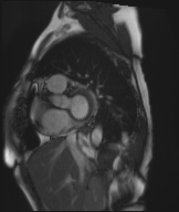 Cardiac amyloidosis (Radiopaedia 51404-57150 Sagittal CINE SSFP 252).jpg