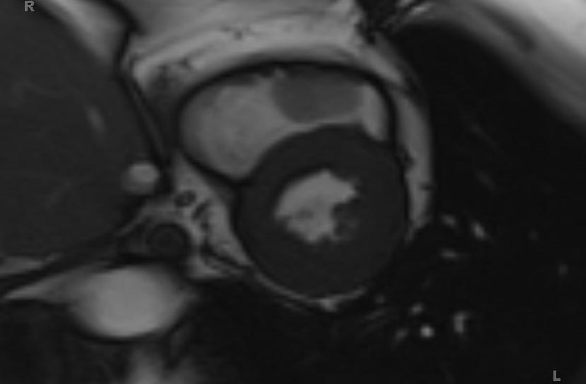 Cardiac hemangioma (Radiopaedia 31709-32631 Short axis Cine SSFP 44).jpg