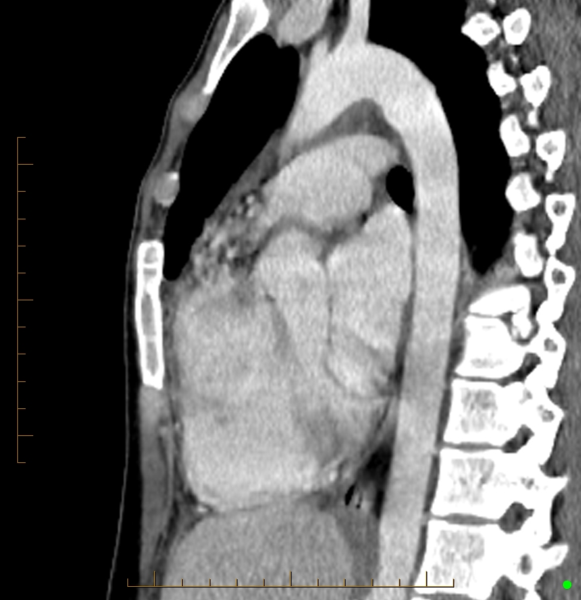 Cardiac paraganglioma (Radiopaedia 76345-88005 C 50).jpg