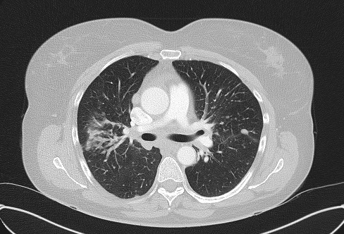 Cardiac sarcoidosis (Radiopaedia 74548-85534 Axial lung window 35).jpg