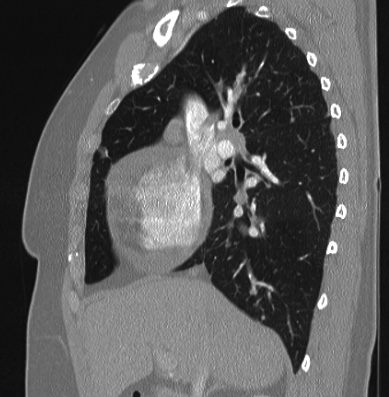 Cardiac sarcoidosis (Radiopaedia 74548-85534 Sagittal lung window 59).jpg