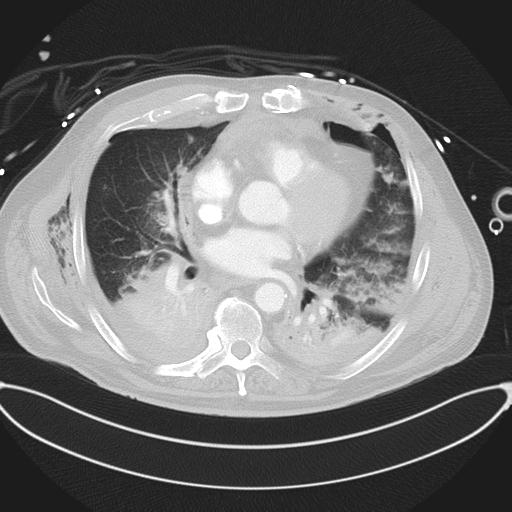 Cardiac trauma (Radiopaedia 32874-33858 Axial lung window 31).jpg
