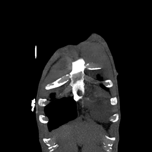 Cardiac tumor - undifferentiated pleomorphic sarcoma (Radiopaedia 45844-50134 Coronal non-contrast 3).png