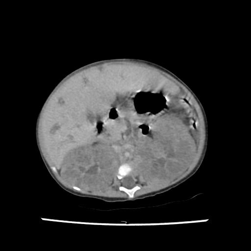 Caroli disease with autosomal recessive polycystic kidney disease (ARPKD) (Radiopaedia 89651-106703 B 93).jpg