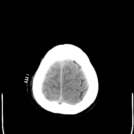 File:Carotid arterial dissection (Radiopaedia 30001-30548 Axial non-contrast 27).jpg